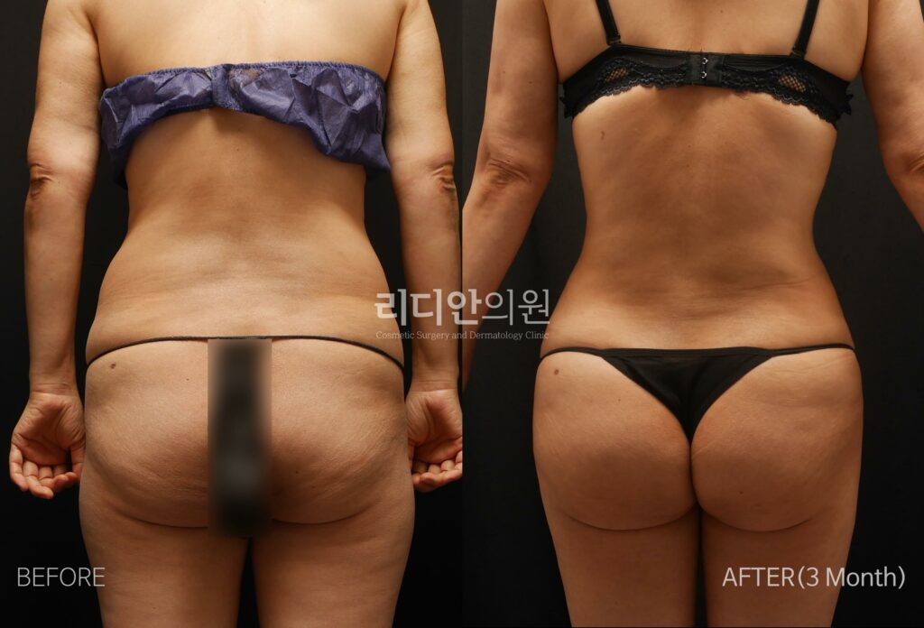 Body Contouring Before and After Photo - Female Rear