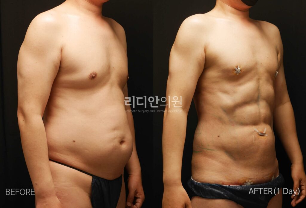 Body Contouring Before and After Photo - Male Upper Body