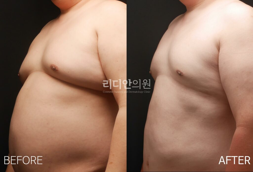 Body Contouring Before and After Photo - Male Upper Body 2